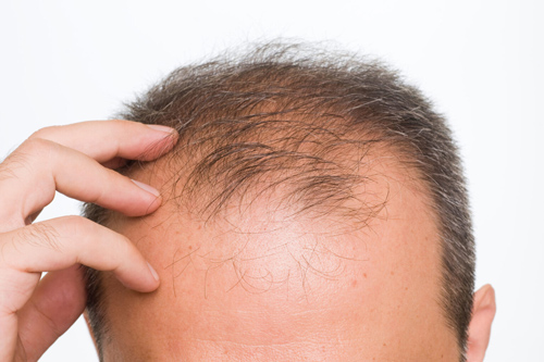 برای جلوگیری از ریزش مو چه بخوریم | بهترین قرص ویتامین برای ریزش مو | جلوگیری از ریزش مو خانگی