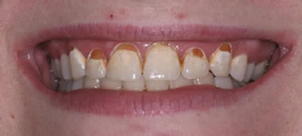 عوارض کامپوزیت دندان های جلو