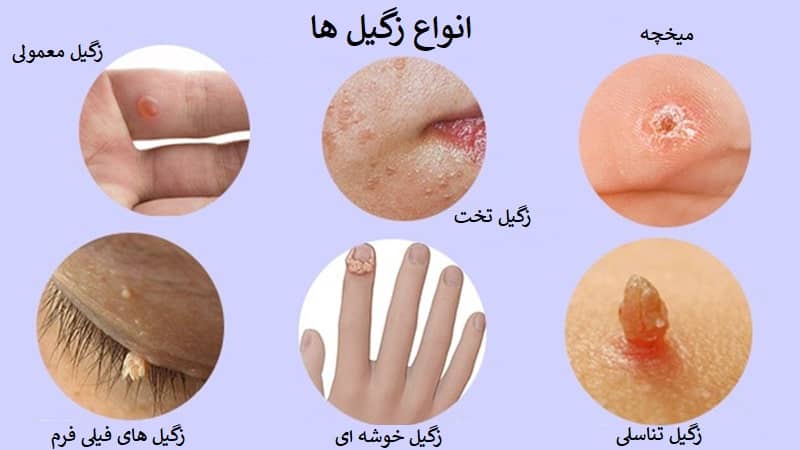 زگیل تناسلی