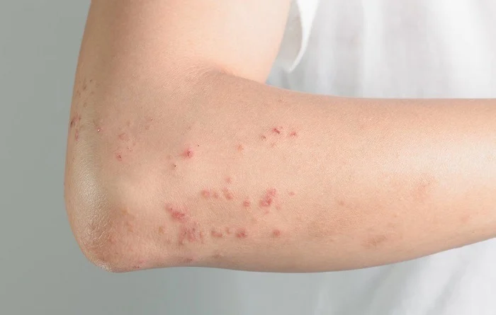 Cause of urticaria at night and treatment method