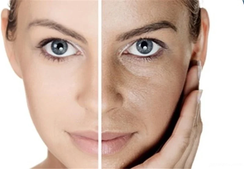 Laser face or face lift