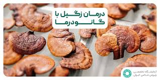 زگیل تناسلی